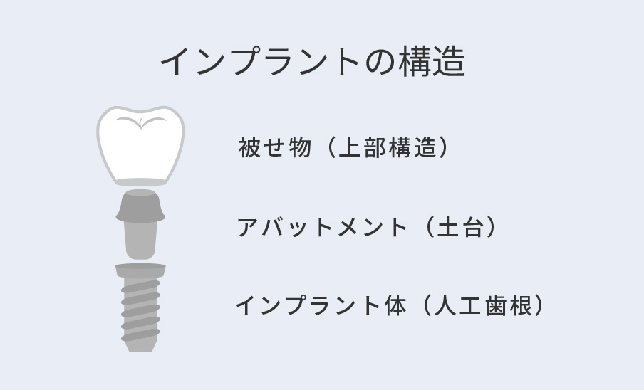 インプラントの構造 被せ物(上部構造)、アバットメント(土台)、インプラント体(人工歯根)