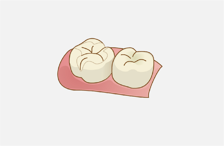コンポジットレジン