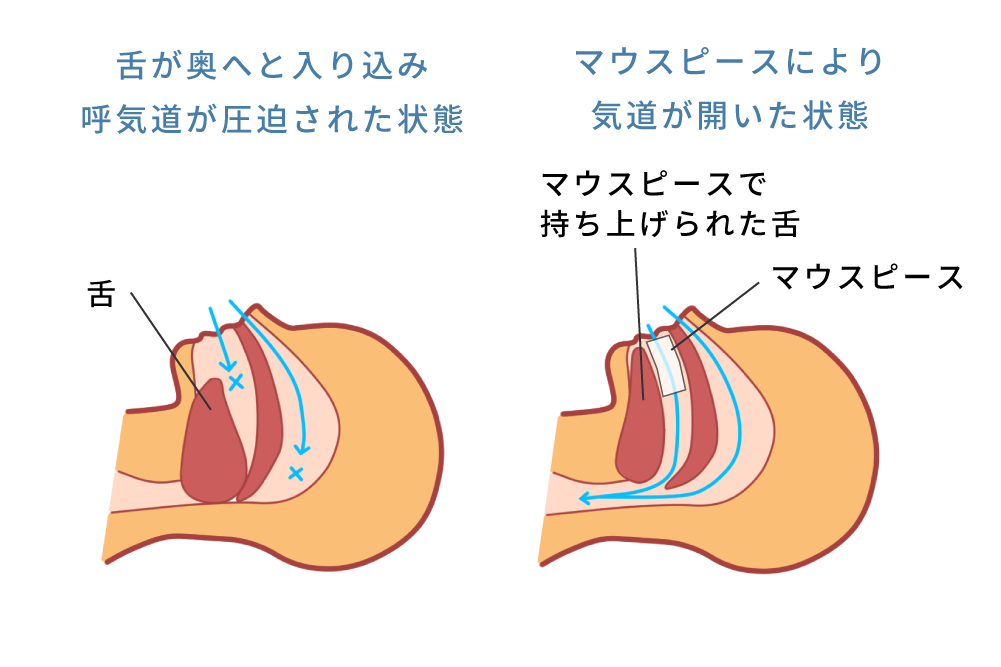 マウスピース治療で気道が開くイメージ