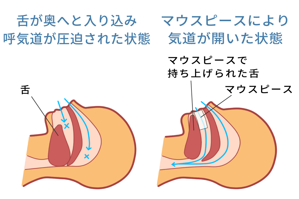 マウスピース治療で気道が開くイメージ