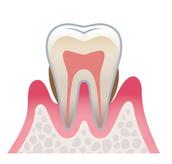 中度歯周炎